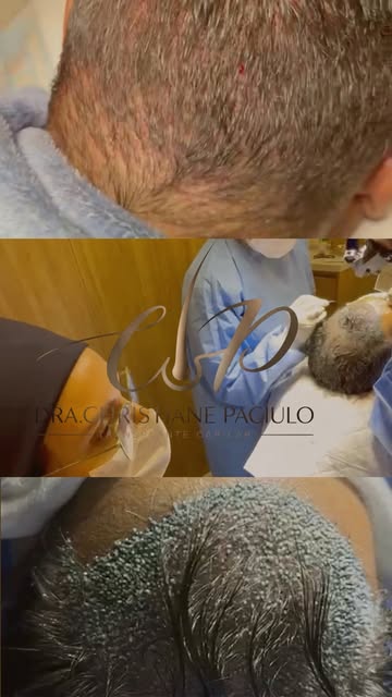 Um resultado natural começa muito antes de os fios crescerem.

Cada etapa do transplante capilar exi
