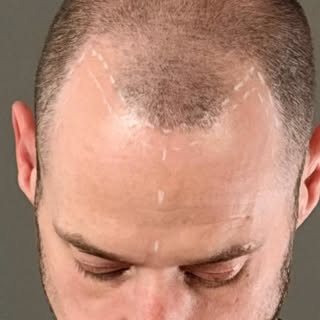 Density SMP | 2 Sessions

This client wanted to reduce scalp visibility, strengthen the appearance o