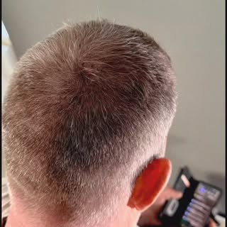 Only two density sessions completed so far 👌

Natural crown restoration using scalp micropigmentati