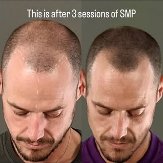 Three sessions in so far, Natural progression.

SMP isn’t about creating a new hairline or making so