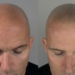 A natural result, designed for the individual.

Scalp Micropigmentation isn’t about creating the per