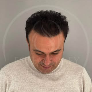 An example of a hair transplant procedure performed within the scope of our health tourism authoriza