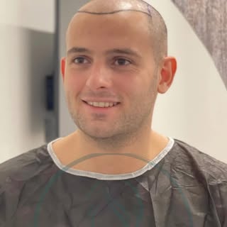 Hair transplantation 

An example of a hair transplant procedure performed within the scope of our h