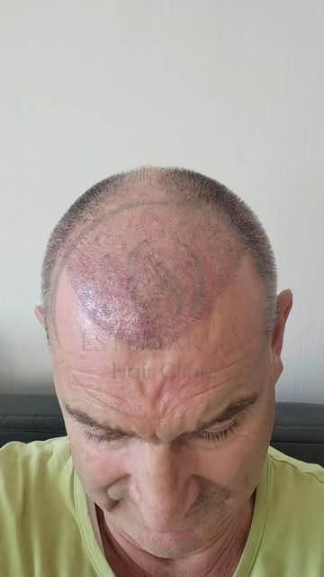 12 mois. Une transformation. 🔥
Parcours de greffe de cheveux

Our posts are for informational purpo