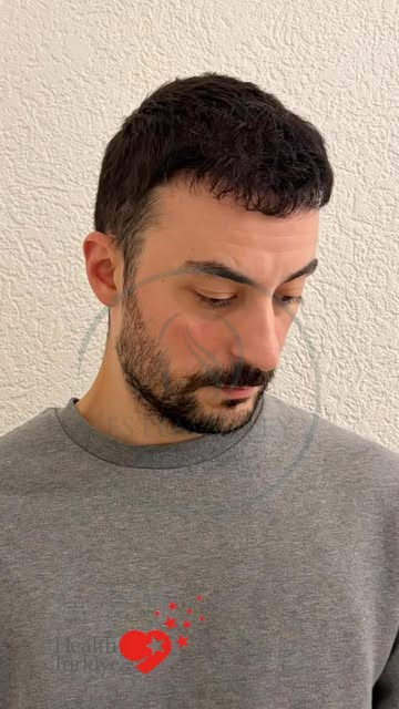 8. Monat nach einer Haartransplantation mit der DHI Technik

An example of a hair transplant procedu