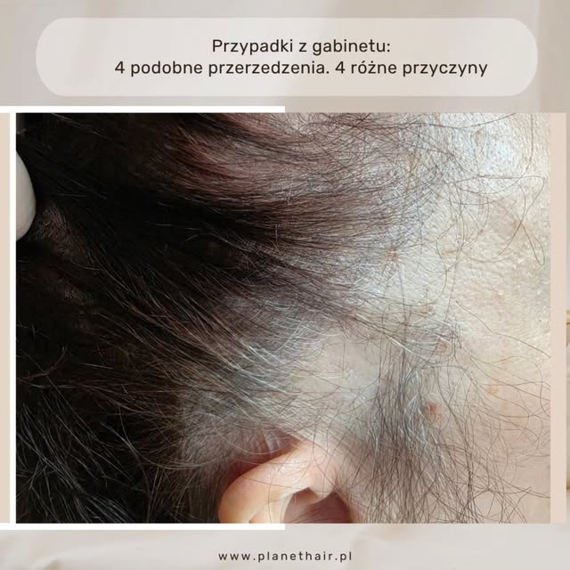 Ta sama okolica. Podobne przerzedzenie. Zupełnie różne przyczyny. 🔍

Na zdjęciach widzisz cztery pr