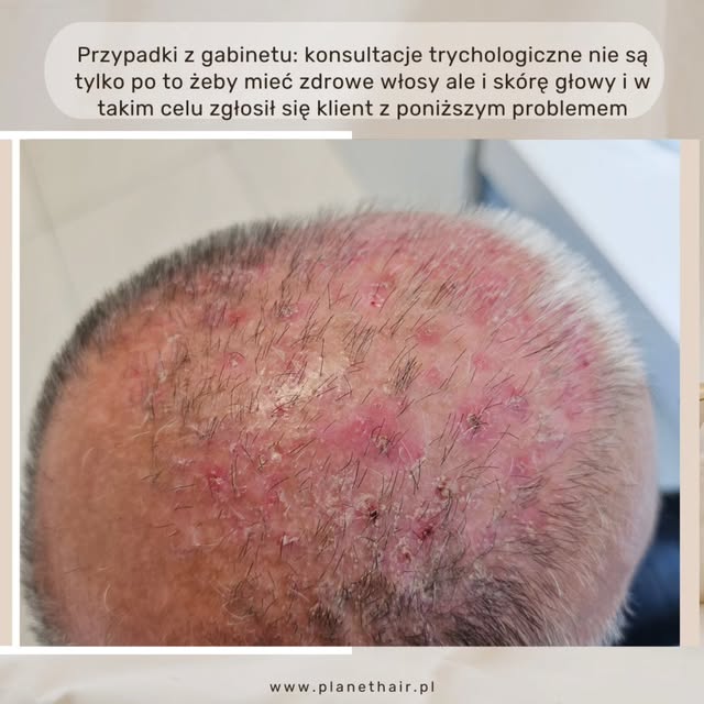 Trycholog nie jest tylko „od wypadania włosów”.

Do gabinetu przychodzą również osoby z bardzo zaawa