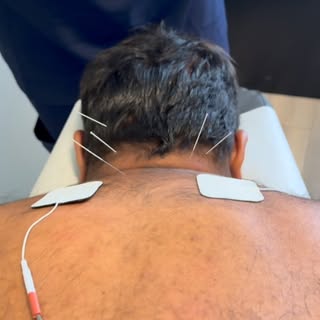 At Winter Park Regenerative Medicine, we combine acupuncture with TENS (Transcutaneous Electrical Ne