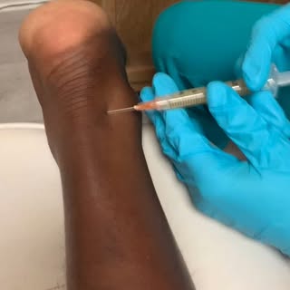 Achilles tendon pain slowing you down? 🦶✨ PRP and exosome injections at Winter Park Regenerative Me