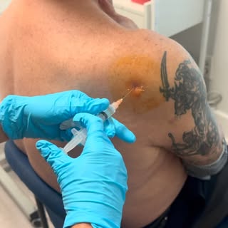 Shoulder pain holding you back? 💪

At Winter Park Regenerative Medicine, exosome injections are use