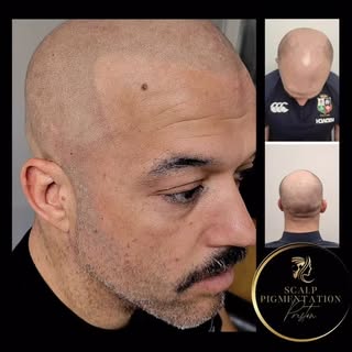 One Final ‘SMP Session’ required to complete ⬆️✅ Established & Trusted 🏆 ‘Scalp Micropigmentation C