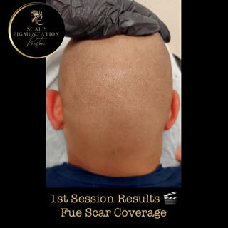 Hair Transplant FUE Scar Coverage ⬆️ Session One Results 🎬 Scalp Micropigmentation (SMP) is a popul