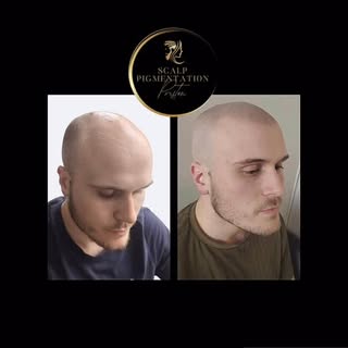 Scalp Micropigmentation SMP’ ⬆️✅ Established & Trusted 🏆 ‘Scalp Micropigmentation Clinic’ Preston C
