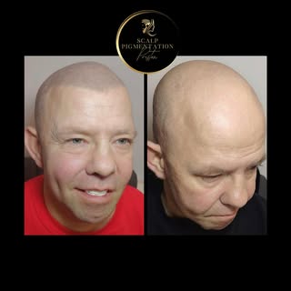 Scalp Micropigmentation Preston ⬆️✅ Established & Trusted 🏆 ‘Scalp Micropigmentation Clinic’ Presto