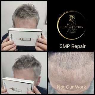 3rd Session SMP Repair ✔️ Client didn’t want laser removal 🚦Pigment was deposited too deep into the
