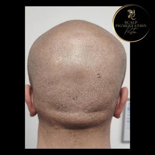 Hair Transplant FUE Scar Coverage ⬆️ 2nd Session Results - Scalp Micropigmentation (SMP) is a popula
