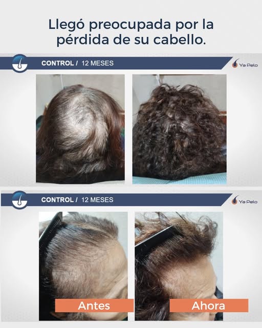 Ella es Ana. Llegó a Ya Pelo con una preocupación que cada vez se hacía más grande: estaba perdiendo