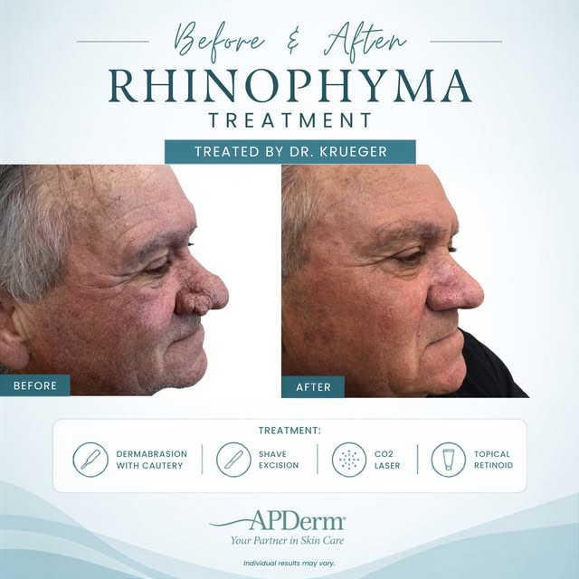 Rhinophyma Before & After

This patient was treated for rhinophyma, a condition characterized by thi