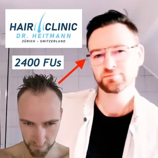 Morgenroutine von Dr. Lars Heitmann`s Patient Joachim @j.j.hansen/ nach 2400 Grafts in die Haarlinie