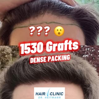 Ein tiefer Haaransatz ohne Geheimratsecken? 🤔Vorher-Nachher Beispiel   Im Video zu sehen ein Zwisch