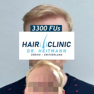 Haartransplantation mit FUE & 3300 FUs auf den Vorderkopf | Dünne, blonde Haare | Davids Mutter wurd