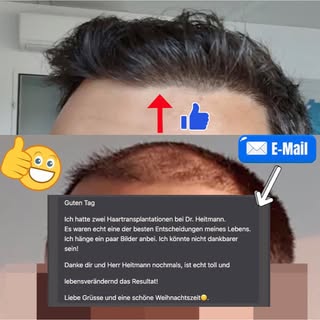 Zufriedener Patient nach Korrektur einer verpfuschten Haartransplantation:  
Ein Patient wandte sich