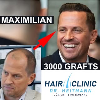 Maximilians Haartransplantation bei Dr. Heitmann – 11 Monate später! ✅⠀
⠀
Vor 11 Monaten hat sich Ma