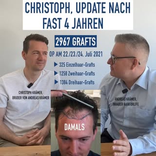 Christophs 4-Jahres-Update zur Haartransplantation bei Dr. Heitmann in Zürich✨ | 2967 FUs 
Immer wie