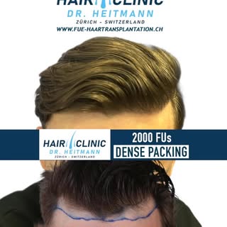 FUE Haartransplantation Resultat mit Dense Packing: Dr. Heitmann transplantiert diesem Patient 2000 