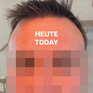 Kunden-Mail: Haartransplantation Ergebnis bei Dr. Heitmann ✅

Ein Patient kam zu Dr. Heitmann mit de