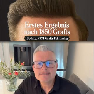 FUE-Haartransplantation Haarlinie: 1.850 + 774 Grafts Feintuning

Dieser Patientenfall zeigt ein bew
