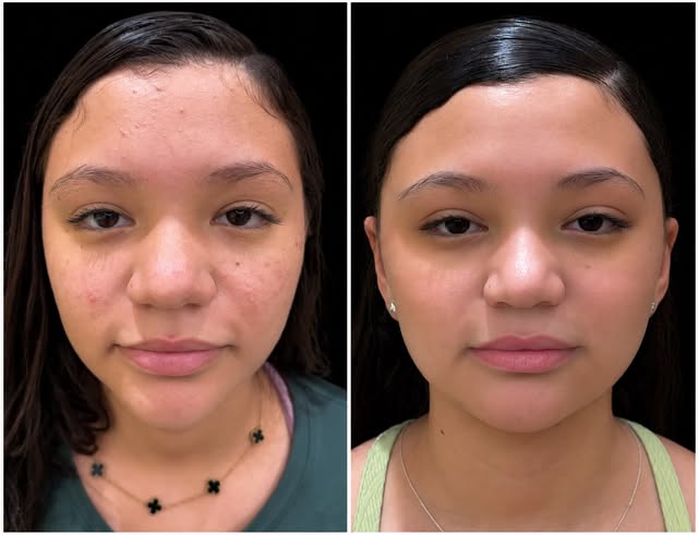 ✨ Acne na adolescência: quanto antes cuidar, melhor!

Aos 13 anos, Júlia chegou até mim com a autoes