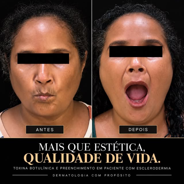 Um dos procedimentos mais especiais que eu já fiz !🫶🏻.

Esta paciente tem esclerodermia, uma doenç