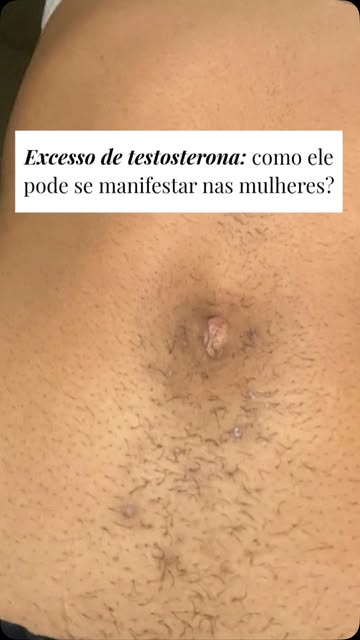 Pelos aumentando, acne aparecendo e cabelo caindo ao mesmo tempo? Talvez esses sinais estejam conect