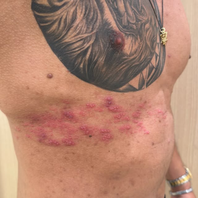 🚨 HERPES-ZÓSTER: SEU CORPO PODE ESTAR DANDO UM SINAL DE ALERTA

Você sabia que aquele quadro de dor