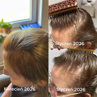 Uwielbiam takie efekty!✨Wielkie brawa dla mojej Pacjentki 👏😍Pierwszą konsultację odbyłyśmy w stycz