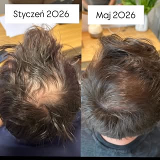 Łysienie androgenowe typu męskiego - 5 miesięcy intensywnej pracy. Widzimy już pierwsze efekty, duży