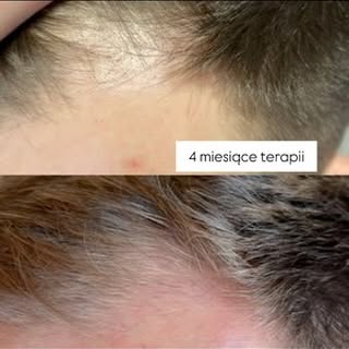 Łysienie androgenowe typu męskiego. Efekty 4 miesięcy współpracy. Pierwsze efekty już widać, teraz c