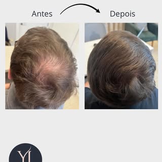 Resultado após quatro sessões de tratamento clínico.

A evolução desse paciente foi impressionante: 