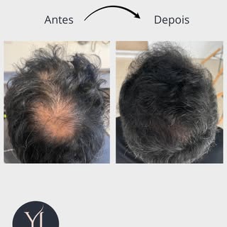 Antes e depois real, com ciência, constância e acompanhamento clínico.

Esse resultado é de um pacie