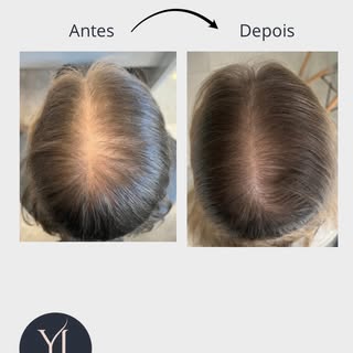 Alopecia Androgenética Feminina

Neste antes e depois, é possível observar a evolução de uma pacient