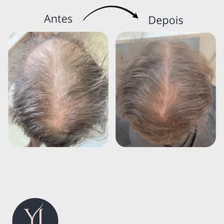 3 meses. E a diferença já é visível.

Quando falamos em tratamento capilar, não existe transformação