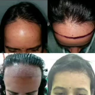 FUE HAIR TRANSPLANT

INVERS AESTHETIC 
For complete Health Fitness Body and Beauty ( Face, Skin & Ha