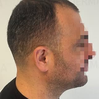 ❌TRICOPIGMENTAZIONE SU CICATRICE DA INTERVENTO CHIRURGICO‼️ 

TRICOPIGMENTAZIONE COME RICHIESTA DAL 