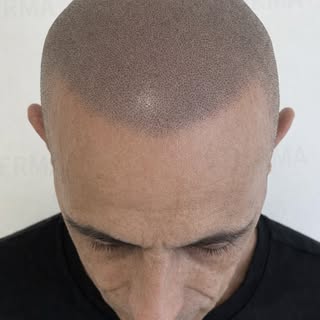 TRICOPIGMENTAZIONE COME RICHIESTA DAL CLIENTE.

Nascondi la calvizie con la 𝐓𝐫𝐢𝐜𝐨𝐩𝐢𝐠𝐦𝐞𝐧𝐭