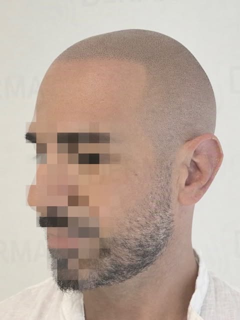 TRICOPIGMENTAZIONE COME RICHIESTA DAL CLIENTE.

Nascondi la calvizie con la 𝐓𝐫𝐢𝐜𝐨𝐩𝐢𝐠𝐦𝐞𝐧𝐭