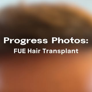 Check out the progress of this Patients successful hair transplant. From a thinning scalp to a full 