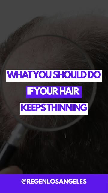 Hair loss doesn’t have to define your look. ✨

Hair transplantation can help restore the appearance 