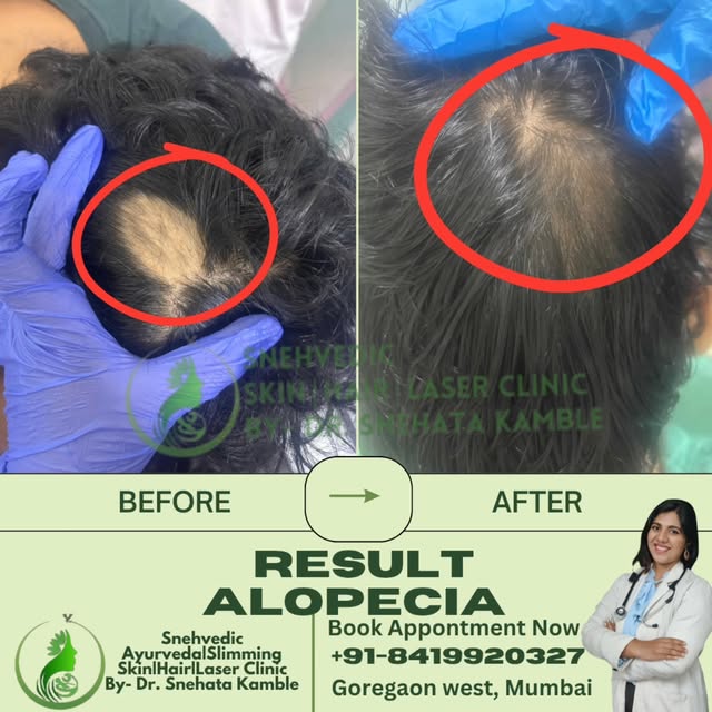 We’re happy to share that you are getting good results for your hair treatment at Snehvedic Clinic, 