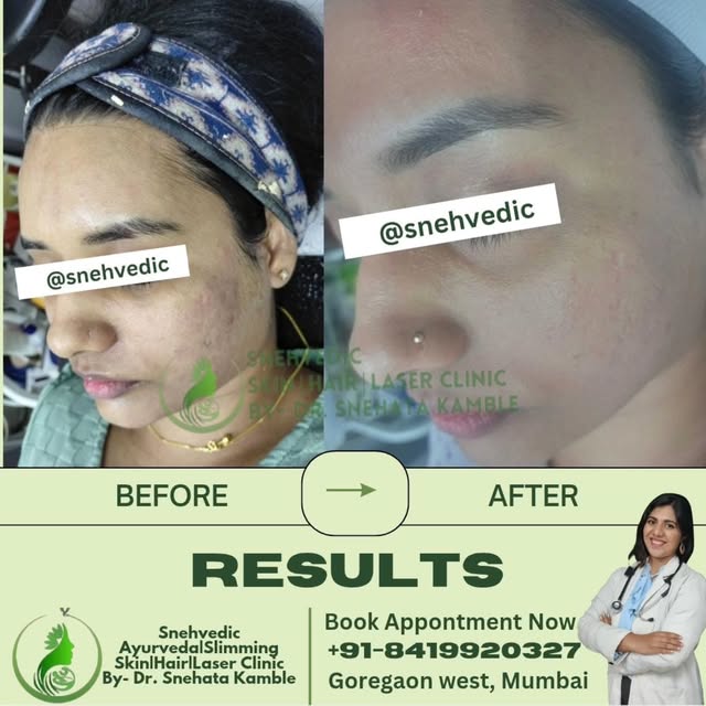 ✨ Clear skin, new confidence! ✨ Say goodbye to acne scars with our advanced treatments at Snehvedic 